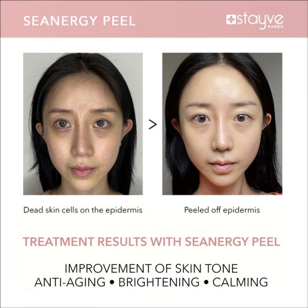 Stayve Seanergy Peel – Professional Skin Exfoliation & Brightening Treatment - Image 7