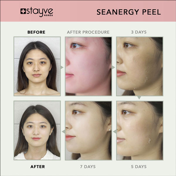 Stayve Seanergy Peel – Professional Skin Exfoliation & Brightening Treatment - Image 4